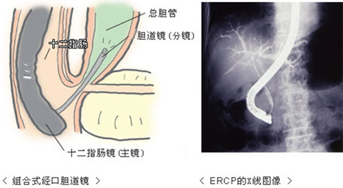 脾胃肝胆完成"镜面人"ercp术,全球在录仅十余例
